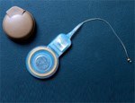 Cochleair implantaat: implanteerbaar hoortoestel